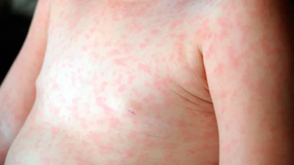 sarampion1600-1024x576